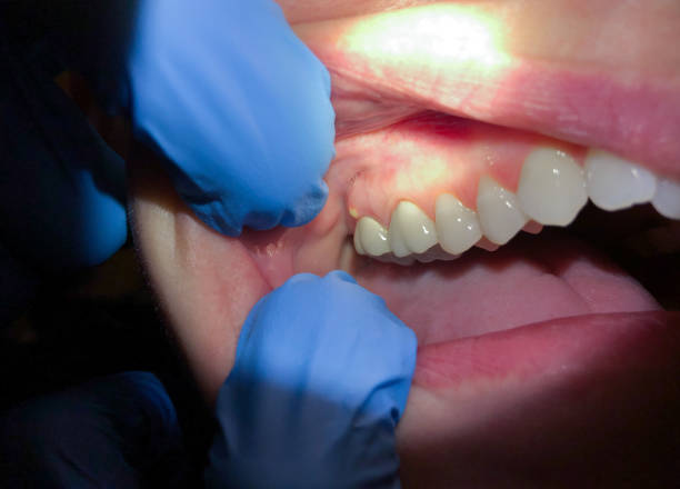 Best Broken or Chipped Tooth Repair in Branchville, SC