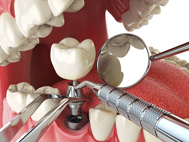 Best Emergency Wisdom Tooth Extraction in Branchville, SC